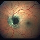 Melanocytoma